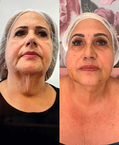 antesedepois2